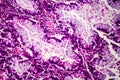 Villous colon adenocarcinoma, light micrograph