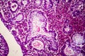 Villous colon adenocarcinoma, light micrograph