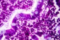 Villous colon adenocarcinoma, light micrograph Royalty Free Stock Photo