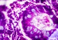Villous colon adenocarcinoma, light micrograph Royalty Free Stock Photo