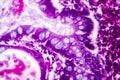 Villous colon adenocarcinoma, light micrograph Royalty Free Stock Photo