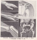Vintage illustration of Dislocation 1930s.