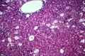 Viral hepatitis, light micrograph