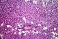 Viral hepatitis, light micrograph