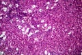 Viral hepatitis, light micrograph