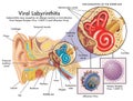 Viral labyrinthitis illustration