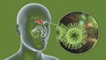 Viral sinusitis, inflammation of paranasal cavities and close-up view of viruses