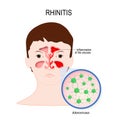 Viral sinusitis Rhinitis caused by adenovirus Royalty Free Stock Photo