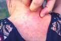 Viral skin disease Measles rash women with dermatitis of Itching of the blister on Occipital.