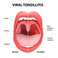 Viral tonsillitis Royalty Free Stock Photo
