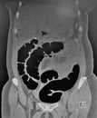 Virtual colonoscopy ct scan image.