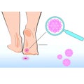 Virus on heel on a white background. Vector illustration