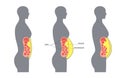 Visceral fat diagram