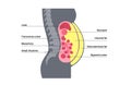 Visceral fat diagram