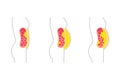 Visceral fat diagram