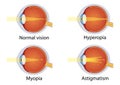 Vision disorders. Concept of eyes defect. Normal vision, hyperopia, myopia, astigmatism. Anatomy eyeball. Vector