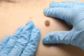 Visual examination of the mole for the presence of malignant neoplasms. Prevention for detecting skin cancer and melanoma Royalty Free Stock Photo