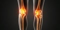 Visual Representation Of Osteoarthritis-Induced Joint Inflammation In Leg, Impacting Bone Wellness