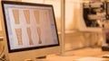 A visualization of the computer modeling process for a 3Dprinted prosthetic featuring software calculations and design