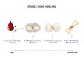Visualizing bone fracture healing stages from hematoma to remodeling Royalty Free Stock Photo