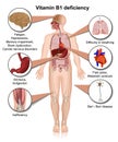 Vitamin B1 deficiency 3d medical vector illustration infographic on white background thiamine