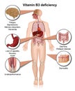 Vitamin b3 deficiency, 3d medical vector infographic isolated on white background