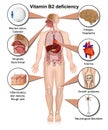 Vitamin B2 deficiency infographic, 3d medical illustration on white background