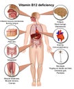 Vitamin B12 deficiency infographic, 3d medical vector illustration on white background