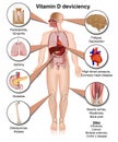 Vitamin D deviciency body effects medical illustration on white background