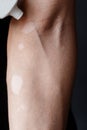 Vitiligo close-up well hands on a black background