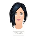 Vitiligo concept