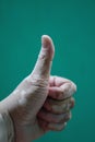 vitiligo on hand on dark green background Royalty Free Stock Photo