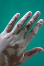 vitiligo on hand on dark green background