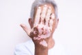 Vitiligo disease on old hand. Royalty Free Stock Photo