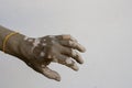Vitiligo disease on old hand. Royalty Free Stock Photo