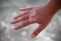 Vitiligo on the hand on the sea background