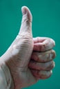 vitiligo on the hand