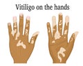 Vitiligo on the hands