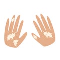 Vitiligo on the hands. White spots on the skin of the hands. Infographics vector illustration.