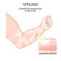 Vitiligo. Cross section of the skin that lose its color