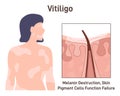 Vitiligo. Leucoderma skin anatomical structure. Long-term skin