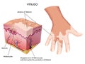 Vitiligo