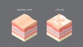 vitiligo and normal skin cross-section of human skin layers structure skincare medical concept flat horizontal