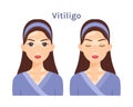 Vitiligo. Portrait of Isolated Beautiful Brunette woman. Cute face. Skin disease.Treatment. Depigmentation skin. Woman with open