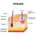 Vitiligo Royalty Free Stock Photo