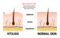 Vitiligo skin disease and healthy skin infographic. Melanocytes stop producing melanin. Skin anatomy. Flat vector illustration