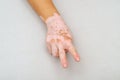 Vitiligo on skin of hand. Fingers show victory gesture