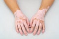 Vitiligo on skin of hands