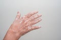 Vitiligo skin problem on woman`s hand closeup on isolated background Royalty Free Stock Photo