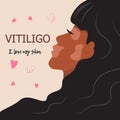 Vitiligo skin. Vitiligo dark female face in profile.